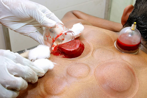 fire-cupping-treatment-in-chennai